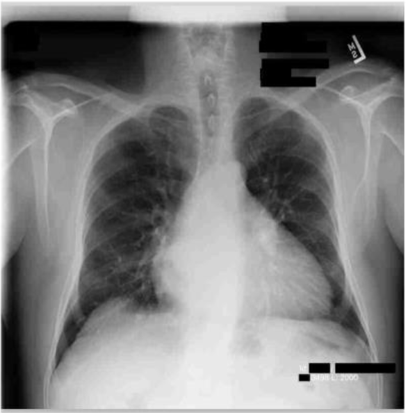 Same chest X-ray with patient identifiers redacted into solid blocks