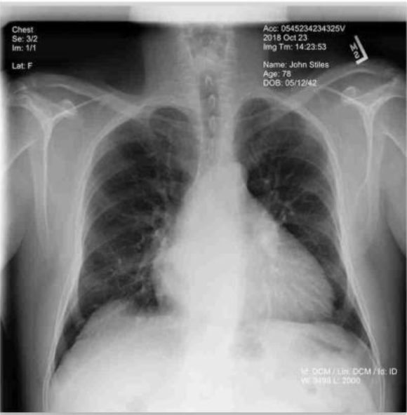 Chest X-ray with burned-in patient identifiers visible